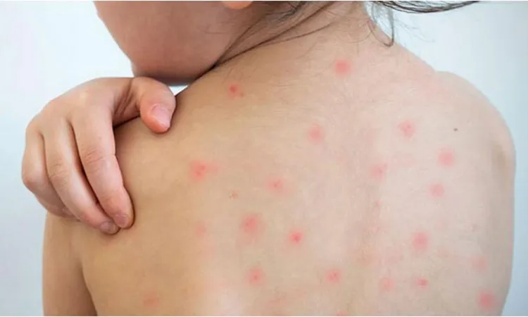 11 Children Die Amid Rising Measles Cases in Bangladesh