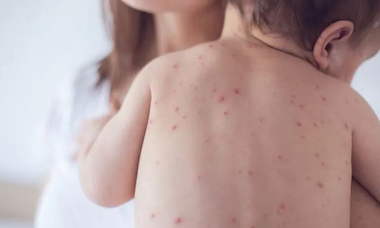 5 More Children Die of Measles and Related Symptoms in 24 Hours