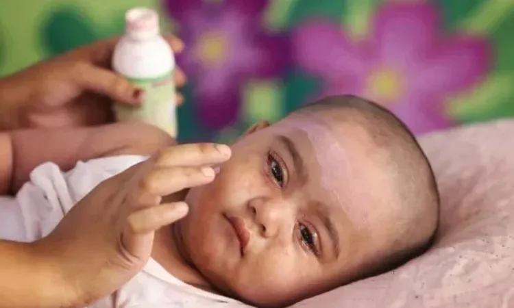 3 More Children Die Measles and Symptom-Related Death Toll Reaches 686